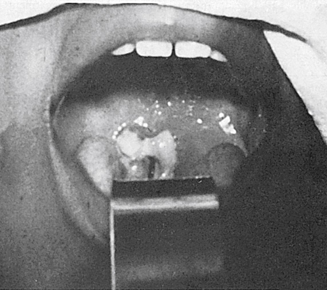 Fig. 130.1, Four-year-old girl with faucial diphtheria.