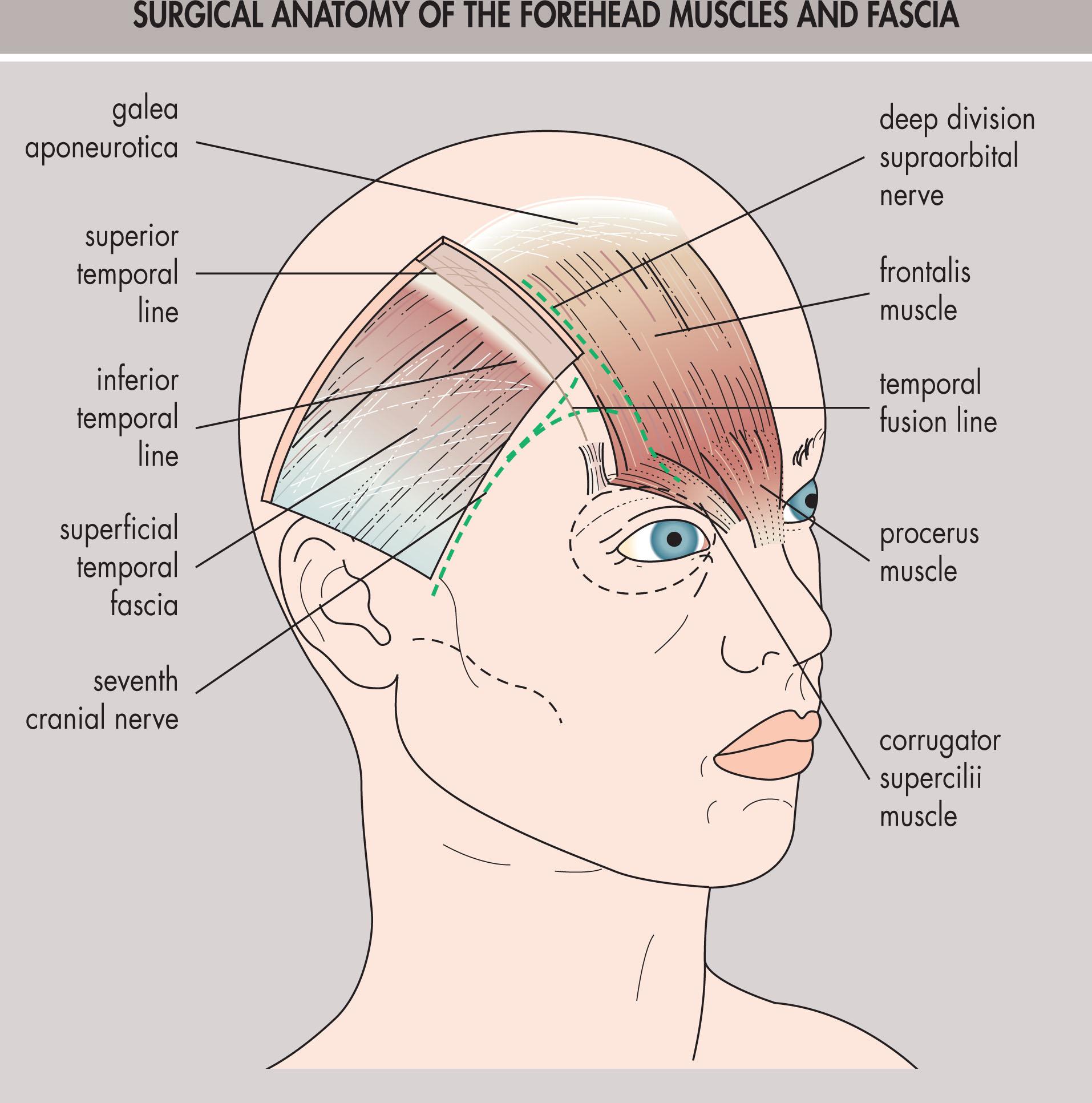 Fig. 12.15.3, Surgical Anatomy of the Forehead Muscles and Fascia.