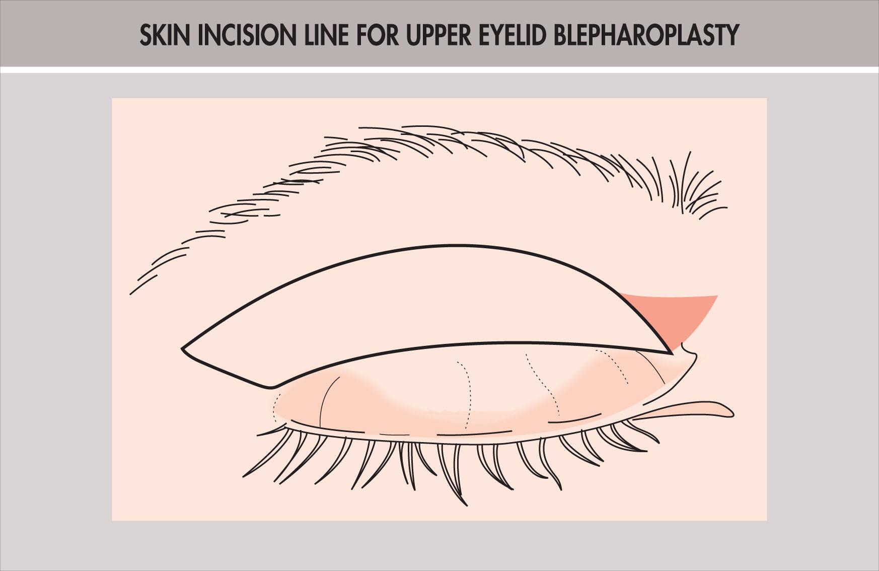 Fig. 12.15.5, Typical Skin Incision Line Used for Upper Eyelid Blepharoplasty.
