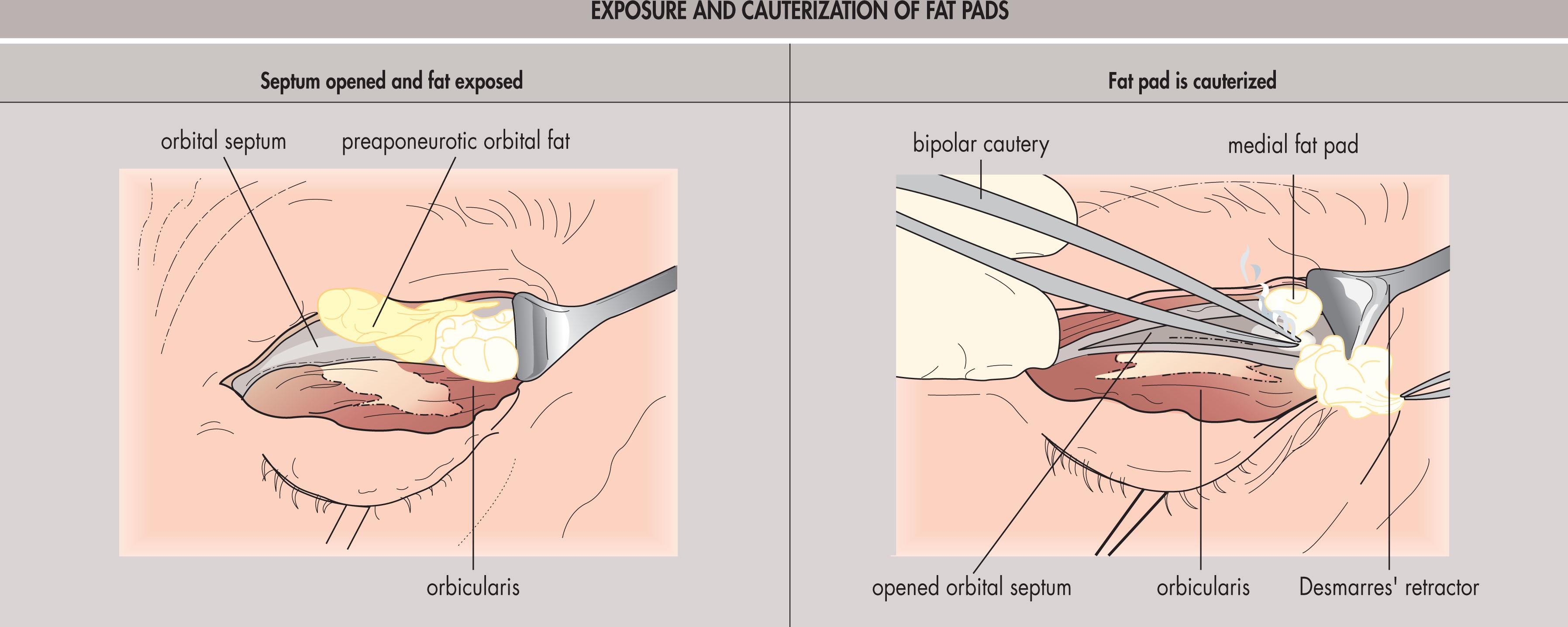 Fig. 12.15.6, Exposure and Cauterization of Fat Pads.