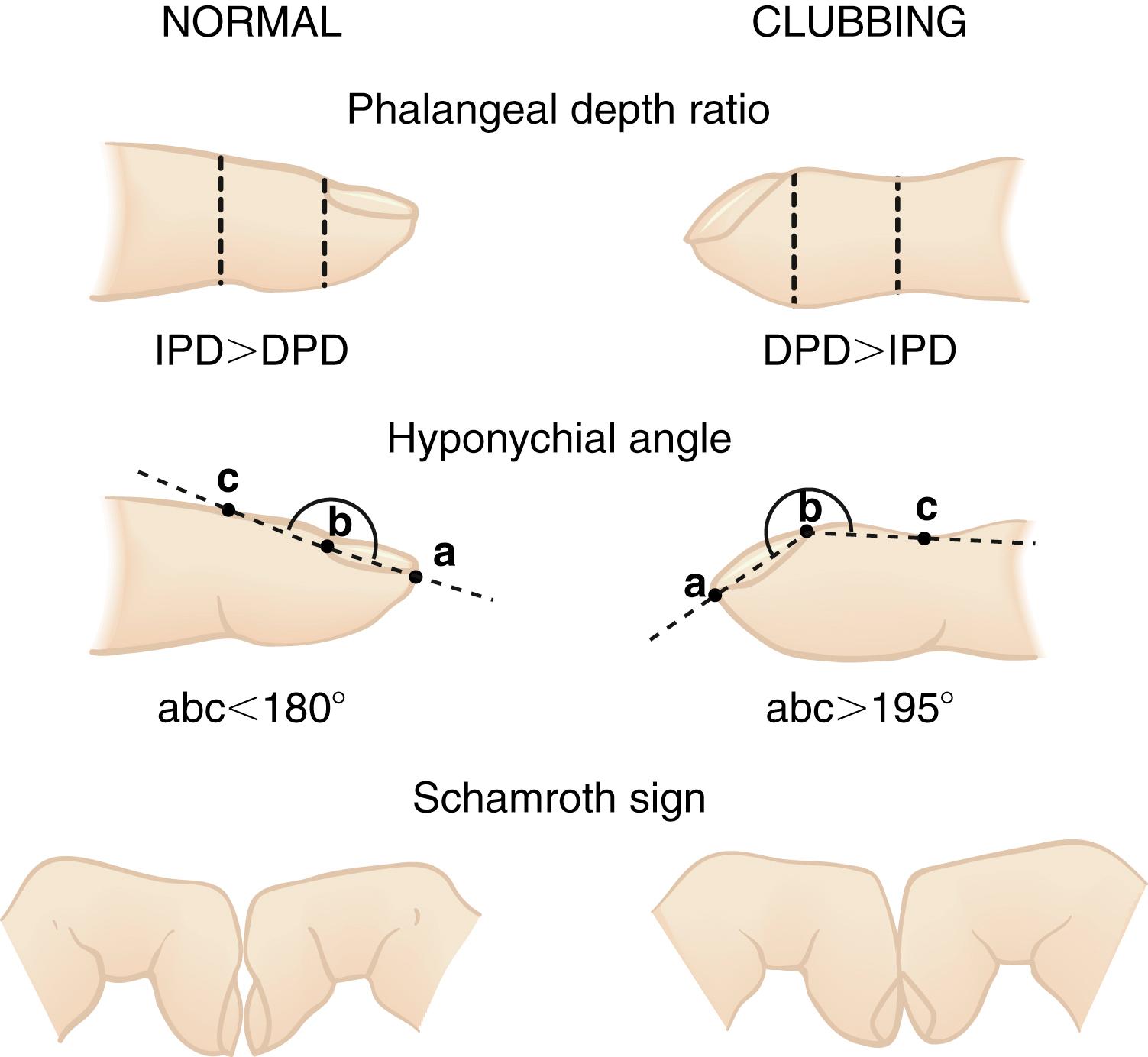 Fig. 3.4, Measurement of digital clubbing. The ratio of the distal phalangeal depth (DPD) to the interphalangeal depth (IPD), or the phalangeal depth ratio, is normally <1 but increases to >1 with finger clubbing. The DPD/IPD ratio can be measured with calipers or, more accurately, with finger casts. The hyponychial angle is measured from lateral projections of the finger contour on a magnifying screen and is normally <180 degrees but >195 degrees with finger clubbing. Schamroth sign is useful for bedside assessment. The dorsal surfaces of the terminal phalanges of similar fingers are placed together. With clubbing, the normal diamond-shaped aperture or “window” at the bases of the nail beds disappears, and a prominent distal angle forms between the end of the nails. In normal subjects, this angle is minimal or nonexistent.