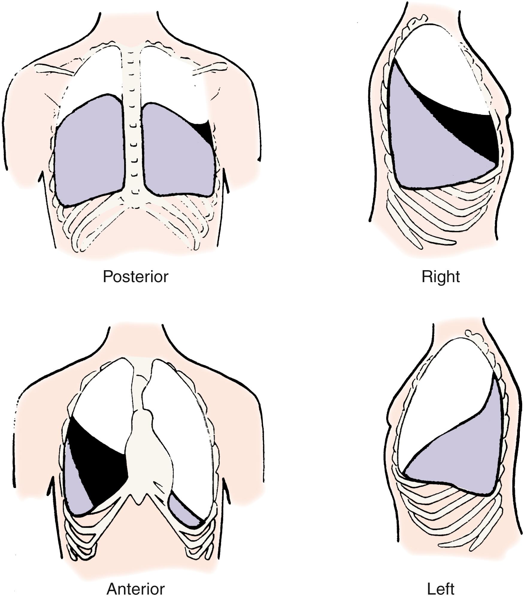 Fig. 3.5, Projections of the pulmonary lobes on the chest surface. The upper lobes are white , the right-middle lobe is black , and the lower lobes are purple .