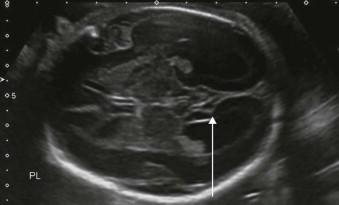 FIGURE 11-11, The normal parieto-occipital fissure on the medial aspect of the hemisphere (line arrow).