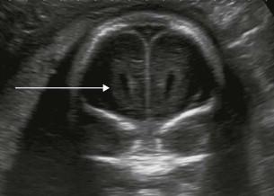 FIGURE 11-15, Coronal section 2. This is a plane through the anterior horns of the lateral ventricle (arrow).