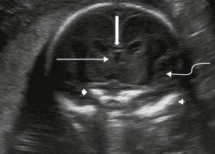 FIGURE 11-16, Coronal plane 3. This is a plane through the genu of the corpus callosum: the cavum septum pellucidum (CSP) (line arrow) and the hypo-echoic corpus callosum (CC) (block arrow) are beautifully demonstrated. Sylvian fissures (curved arrow). Wings of the sphenoid bone (closed arrowhead). Superior orbital margins (open arrowhead).