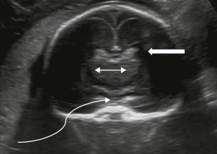 FIGURE 11-17, Coronal plane 4. This is a plane through the thalami. Body of the lateral ventricle containing the choroid plexus (block arrow). Thalami (double arrow). Brainstem (curved arrow).