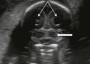 FIGURE 11-18, Coronal plane 5. This is a plane through the occipital horns of the lateral ventricle. Lateral venticles (line arrows). Cerebellum (block arrow).