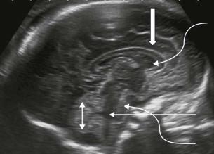 FIGURE 11-19, Midline sagittal plane 1. CC (block arrow). CSP (upper curved arrow). Cerebellum (double arrow). 4th ventricle (line arrow). Pons (lower curved arrow).