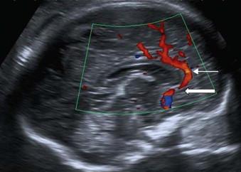 FIGURE 11-20, Midline sagittal plane 2. Anterior cerebral artery (block arrow). First part of the peri-callosal artery following the corpus callosum (line arrow).