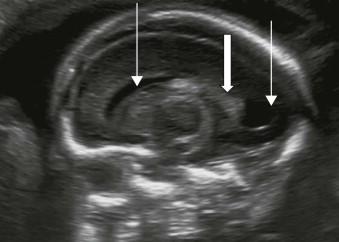 FIGURE 11-21, Parasagittal plane 3. Parasagittal plane. Lateral ventricle (line arrows). Choroid plexus (block arrow).