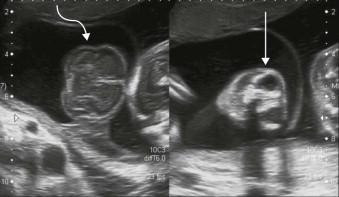 FIGURE 11-22, Anencephaly at 20 weeks. Curved arrow: relatively normal extruded brain substance without covering cranium. Line arrow: frog’s eye appearance due to lack of bone above the orbits.