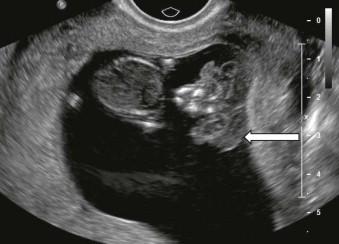 FIGURE 11-24, Exencephaly: the coronal facial appearance of the ‘Mickey Mouse face’ due to the fact that the almost intact brain hemispheres resemble, on a coronal view, large Mickey Mouse ears (arrow).