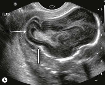 FIGURE 11-26, (A) A moderate-sized occipital encephalocoele demonstrating the herniated brain substance (line arrow) and the cranial defect (block arrow). (B) A cranial meningocoele which contains membranes and fluid only.