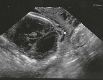 FIGURE 11-27, True encephalocoele. This very small lesion (arrow) was initially only detected on a transvaginal scan.