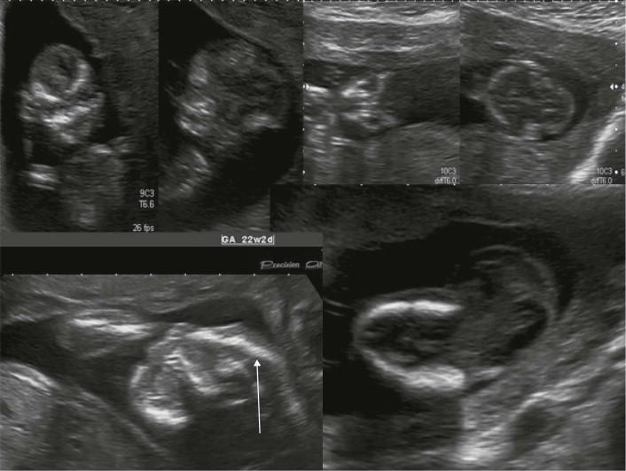 FIGURE 11-28, The changing appearances of an occipital encephalocoele: from top left, clockwise progression to profound microcephaly (line arrow).