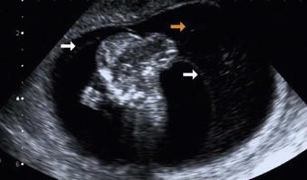 FIGURE 11-29, An encephalocoele due to amniotic band syndrome, with the arrows demonstrating the amnion attachment to the herniated brain substance.