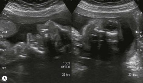 FIGURE 11-30, (A) Profound microcephaly due to an encephalocoele. (B) Profound microcephaly due to an unknown syndrome consisting of microcephaly, frontal lobe atrophy and cerebellar hypoplasia.