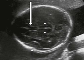 FIGURE 11-4, Transthalamic plane. CSP (block arrow), thalami (double headed arrow), and Sylvian fissure (line arrow).