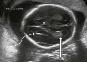 FIGURE 11-5, Transventricular plane. CSP (line arrow), atrium of the lateral ventricle containing the choroid plexus (block arrow), and frontal horns (curved arrow).