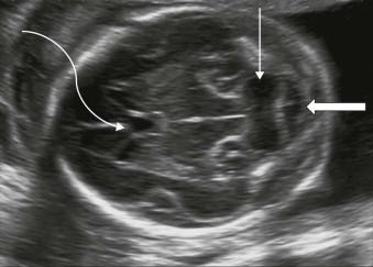 FIGURE 11-6, Transcerebellar plane. CSP (curved arrow), cerebellum (line arrow), and cisterna magna (block arrow).