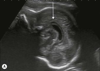 FIGURE 11-7, (A) Sagittal view of corpus callosum. The normal complete curved hypo-echogenic corpus callosum is seen in its entirety (line arrow). (B) The normal rectangular hypo-echoic corpus callosum (line arrow) is seen just below the echogenic falx cerebri (block arrow).