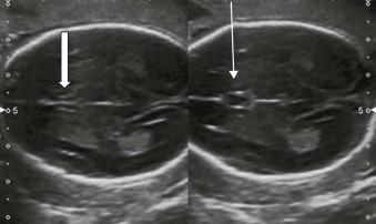 FIGURE 11-8, Normal cavum septum pellucidum and normal fornices, sonographic appearance at 21 weeks. This set of images demonstrates how easy it is to confuse the fornices with the CSP. The CSP is completely anechoic (line arrow), the fornices are separated (block arrow). In a slightly more caudal parallel section, the midline is actually not interrupted. The two commissural fibre bundles running parallel to the midline, the fornices, may give the false impression of the presence of a cavum septum pellucidum.