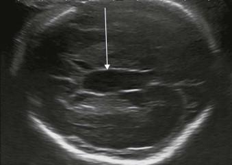 FIGURE 11-9, The normal cavum septum vergae (line arrow).