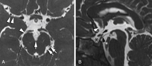 FIGURE 1-12, Cisterns of the brain. A, Axial constructive interference steady state (CISS) image shows the interpeduncular cistern (single arrow), ambient cistern (single arrowhead), perimesencephalic cistern (double arrows), sylvian fissure (double arrowheads), and quadrigeminal plate cistern (double asterisk). The cistern of the lamina terminalis is indicated by single asterisk . B, Sagittal CISS image shows the cistern of the lamina terminalis (arrowhead), suprasellar cistern (single black asterisk), and quadrigeminal plate cistern (double black asterisk). The basilar artery (white asterisk) is seen coursing the prepontine cistern. The chiasmatic recess (black arrow) and infundibular recess (black arrowhead) are also indicated. Note the crowding of structures at the foramen magnum in this patient with borderline Chiari I malformation.