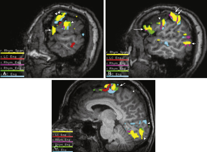 FIGURE 1-13, Functional magnetic resonance imaging (fMRI) with language task. A, fMRI blood-oxygen-level dependent (BOLD) activations overlayed onto anatomic T1-weighted images in sagittal plane. The left side of the brain is shown. Convergent activation is seen in the Broca region (arrow). The Broca region typically corresponds to the pars opercularis/pars triangularis of the inferior frontal gyrus (Brodmann area 44 and 45), and in right handed patients is typically lateralized to the left cerebral hemisphere. Even without overt movement, language related motor areas can show concurrent activation, as is seen in the area of convergent activation in the subcentral gyrus (single arrowhead), which represents the tongue/facial motor regions. The third convergent area of activation is seen in the ventral premotor cortex, also commonly activated during language tasks (double arrowheads). B, Convergent activation is seen in the left inferior frontal gyrus along the pars triangularis and pars opercularis corresponding to Brodmann area 44 and 45, compatible with Broca activation (large single arrow). Activation is also seen in the left ventral premotor cortex (arrowhead), as well as language related motor and sensory areas at the banks of the precentral and postcentral gyri (double arrows). Posterior temporal lobe convergent activation represents Wernicke activation (small single arrow). There are also smaller foci of language-related convergent activation seen just cranial to this in the supramarginal gyrus. C, Convergent activation is seen in the pre-supplemental motor area (arrow), which is activated during language tasks. This is anterior to the supplementary motor area, which is in turn anterior to the precentral gyrus. The central sulcus (asterisk) is seen as the sulcus immediately anterior to the marginal segment of the cingulate sulcus. Visual areas also demonstrate activation (arrowheads) as most of the language tasks used for this patient employed visual language task paradigms.