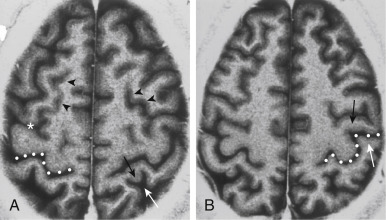 FIGURE 1-16, Central sulcus. A, Note the shape of the medial end of the postcentral sulcus, the bifid “y” (between white and black arrows ) and how the superior frontal sulcus (arrowheads) terminates in the precentral sulcus (asterisk). B, The central sulcus is the next sulcus posterior to the precentral sulcus. Note that precentral gyrus’ cortical gray matter (black arrow) thickness is greater than that of the postcentral gyrus (white arrow) cortical thickness. The central sulcus is indicated by dotted line in both images.