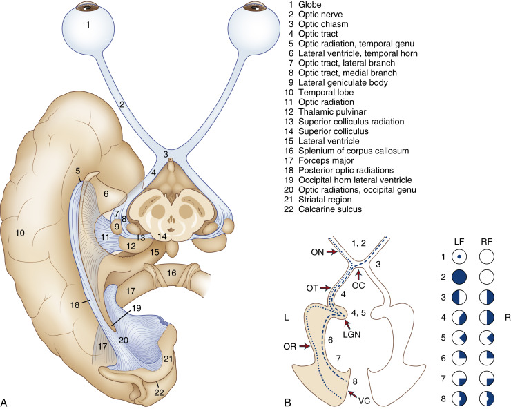 FIGURE 1-18, Visual system anatomy. A, The anatomy of the optic nerves, tracts, and radiations is diagrammed. B, Optic chiasm: correlation of lesion site and field defect. Note the most ventral nasal fibers (mostly from inferior nasal retina) temporarily travel within the fellow optic nerve in Wilbrand knee. LGN, Lateral geniculate nucleus; OC, optic chiasm; ON, optic nerve; OR, optic radiations; OT, optic tract; VC, visual cortex.