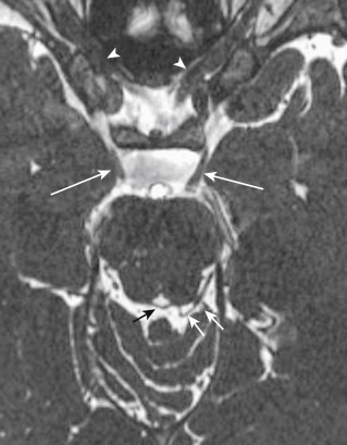 FIGURE 1-4, Midbrain anatomy. This constructive interference steady state (CISS) image shows both oculomotor nerves in their cisternal portions, leading to the cavernous sinus (long white arrows), the left trochlear nerve (double arrows) emanating from the posterior midbrain and coursing the ambient cistern, and the right trochlear nerve decussating posteriorly in the midline (small black arrow). The optic nerves can be seen in the optic canals bilaterally (arrowheads) .