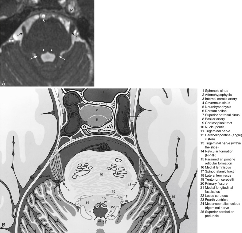 FIGURE 1-5, Pontine anatomy. A, Axial T2 constructive interference steady state (CISS) image shows cranial nerve V exiting the pons (black arrows). Note the superior cerebellar peduncles (white arrows), the Meckel cave on the left (M), medial longitudinal fasciculus (asterisks), and basilar artery (white arrowhead). B, Pontine anatomy at the level of the superior cerebellar peduncle shows several descending and ascending tracts. C, Facial colliculi (arrows) are clearly seen on this axial T2 CISS image. The middle cerebellar peduncle (P) is the dominant structure leading to the cerebellum. Also shown is the cerebellopontine angle cistern (C). D, At the facial colliculus one finds numerous cranial nerve nuclei and traversing lemnisci.