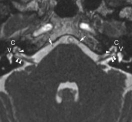 FIGURE 1-6, Lower pontine anatomy. This constructive interference steady state (CISS) image shows the abducens nerve denoted by the white arrows, whereas the cochlear (more anterior) and inferior vestibular nerves (more posterior) are seen bilaterally in the cerebellopontine angle cistern ( single and double white arrowheads, respectively). The fluid-filled cochlea (C) and vestibule (V) are hyperintense on T2.