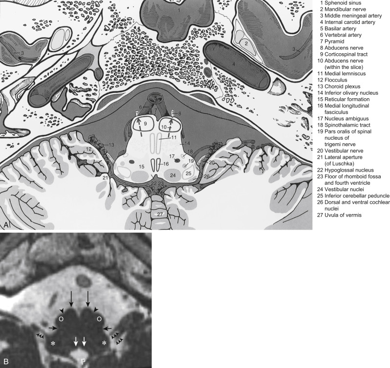 FIGURE 1-7, Medulla anatomy. A, This schematic reveals the junction of the vertebral arteries to the basilar artery. The roots of the abducens nerve arise at the border between the medulla oblongata and pons. The upper part of the inferior olivary nucleus is positioned in the medulla oblongata. B, Axial T2 constructive interference steady state (CISS) shows the preolivary sulcus (short black arrows), the olivary sulcus (single arrowheads), pyramidal tract (large black arrows) and the inferior cerebellar peduncle (asterisks), hypoglossal nuclei (white arrows), and nerve complex (cranial nerves IX and X; small triple arrowheads ). The olive (o) can be seen anteriorly. FIGURE 1-7 , cont’d C, White arrows point out hypoglossal nerves coursing to hypoglossal canals (HC). On either side of the midline posterior cleft are the gracile nuclei (black arrows). Lateral to them will be the cuneate nuclei. D, This schematic shows the numerous nuclei and tracts that are present at the level of the medulla. E, The caudal portion of the medulla oblongata, the rootlets of the hypoglossal nerves, and the hypoglossal canal are included.