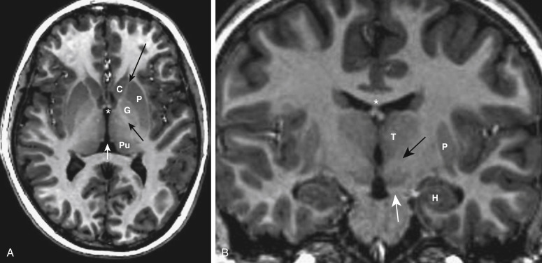 FIGURE 1-10, Deep gray matter anatomy. A, Axial T1-weighted image (T1WI) shows the caudate (C), putamen (P), and globus pallidus (G), as well as the anterior limb (long black arrow) and posterior limb (short black arrow) of the internal capsule. White matter tracts pass between the basal ganglia. The thalamus and periaqueductal gray matter line the third ventricle. The tiny dots of the fornix anteriorly (just ventral to asterisk ) and the posterior commissure posteriorly (white arrow), as well as pulvinar thalamic gray natter (Pu), are also evident. B, On this coronal T1WI, the subthalamic nucleus (black arrow) and substantia nigra (white arrow) can be seen under the thalami (T). The hippocampus (H) is present further laterally. The thalami are joined in the midline at the massa intermedia, and one can also see the forniceal columns (just below asterisk ) projecting above the thalami.