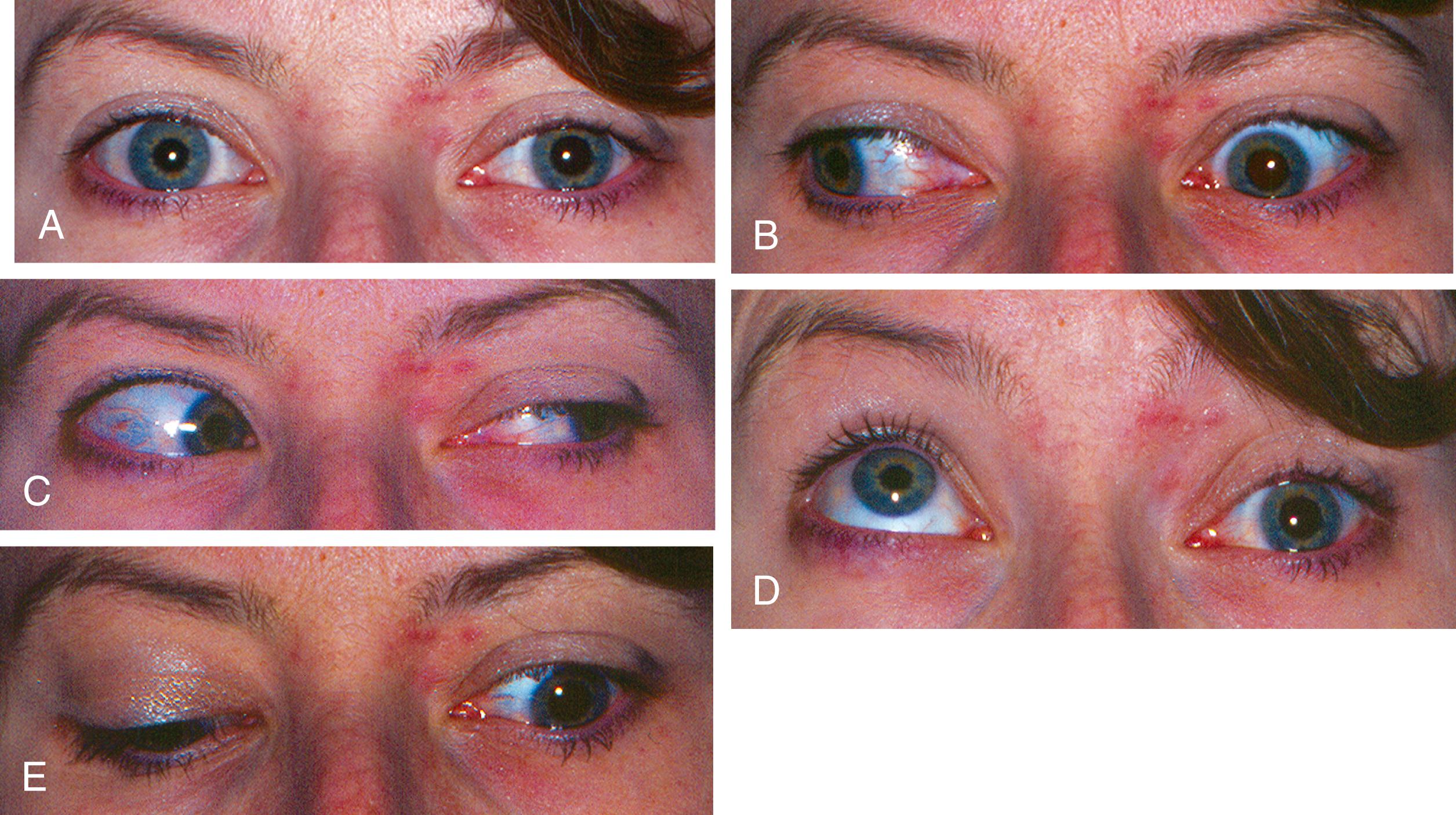 Fig. 103.3, Traumatic left oculomotor palsy 3 months following a motor vehicle accident with closed head injury and loss of consciousness. Patient initially had complete left ptosis and complete absence of adduction, elevation, and depression. Results of magnetic resonance imaging and magnetic resonance angiography were normal. A, Central position with slight left ptosis, exotropia (outward deviation), and left pupillary enlargement. B, Impaired adduction of left eye with right gaze. Note aberrant regeneration with anomalous elevation of left lid upon adduction of left eye. C, Normal left gaze. D, Significant impaired elevation of left eye with upgaze. E, Impaired depression of left eye with downgaze.