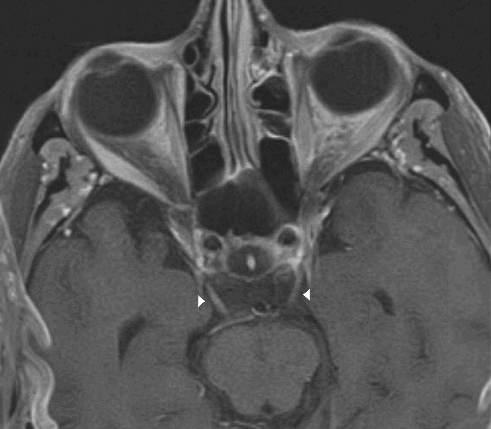 eFig. 103.4, Axial T1-weighted MRI with gadolinium at the level of the midbrain demonstrates abnormal bilateral oculomotor nerve enhancement (arrowheads) .