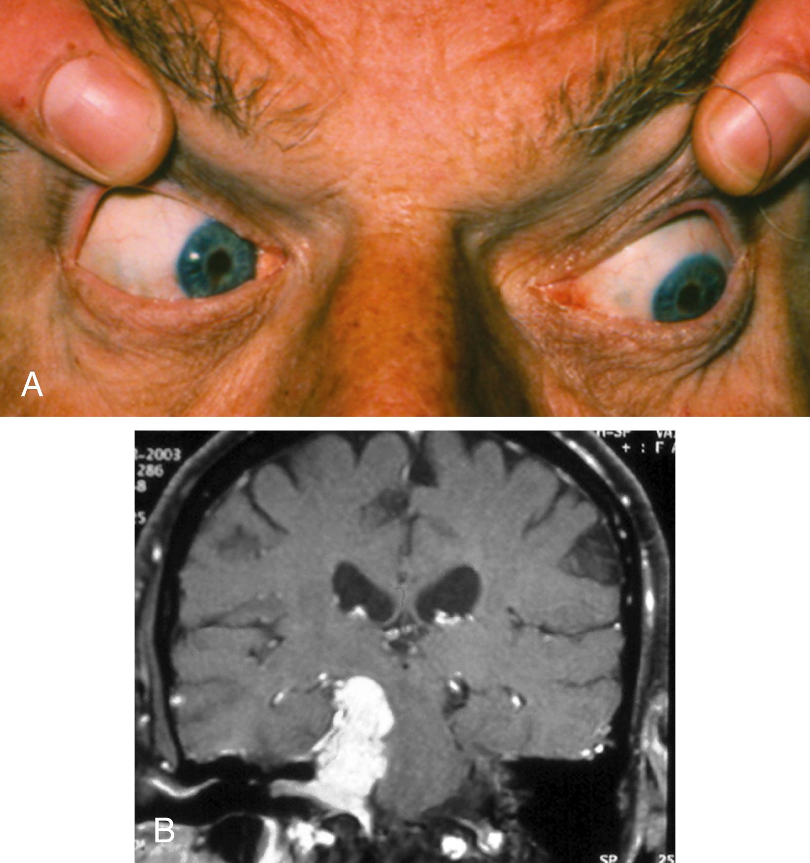 Fig. 103.5, Right Trochlear Palsy From a Large Right Petroclival Meningioma.