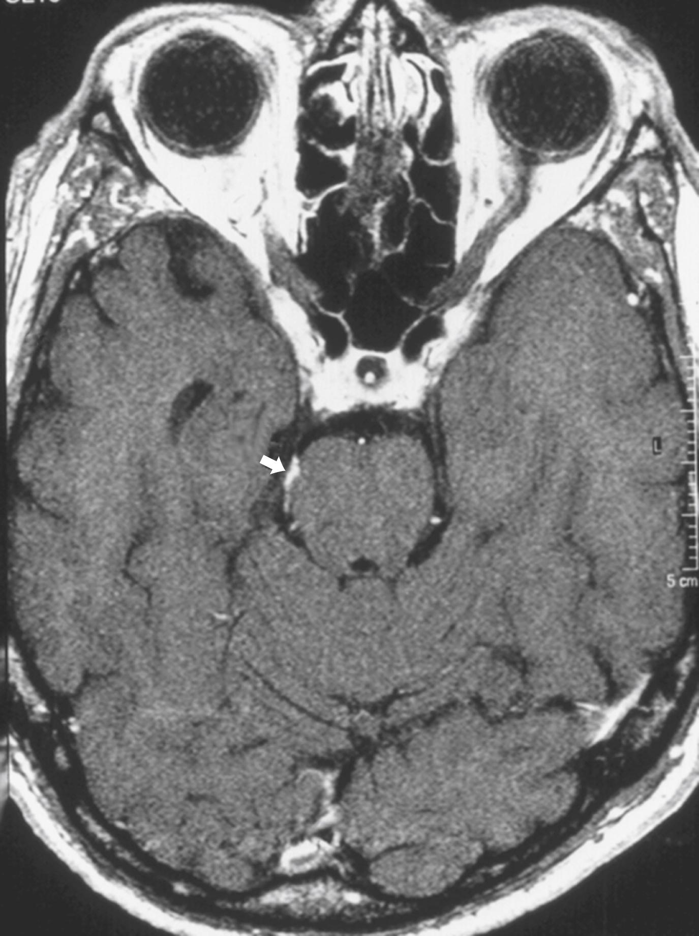 eFig. 103.6, T1-weighted axial magnetic resonance imaging with gadolinium at level of inferior colliculus shows enhancing lesion consistent with a schwannoma (arrow) of right trochlear nerve as it courses ventrally around brainstem.