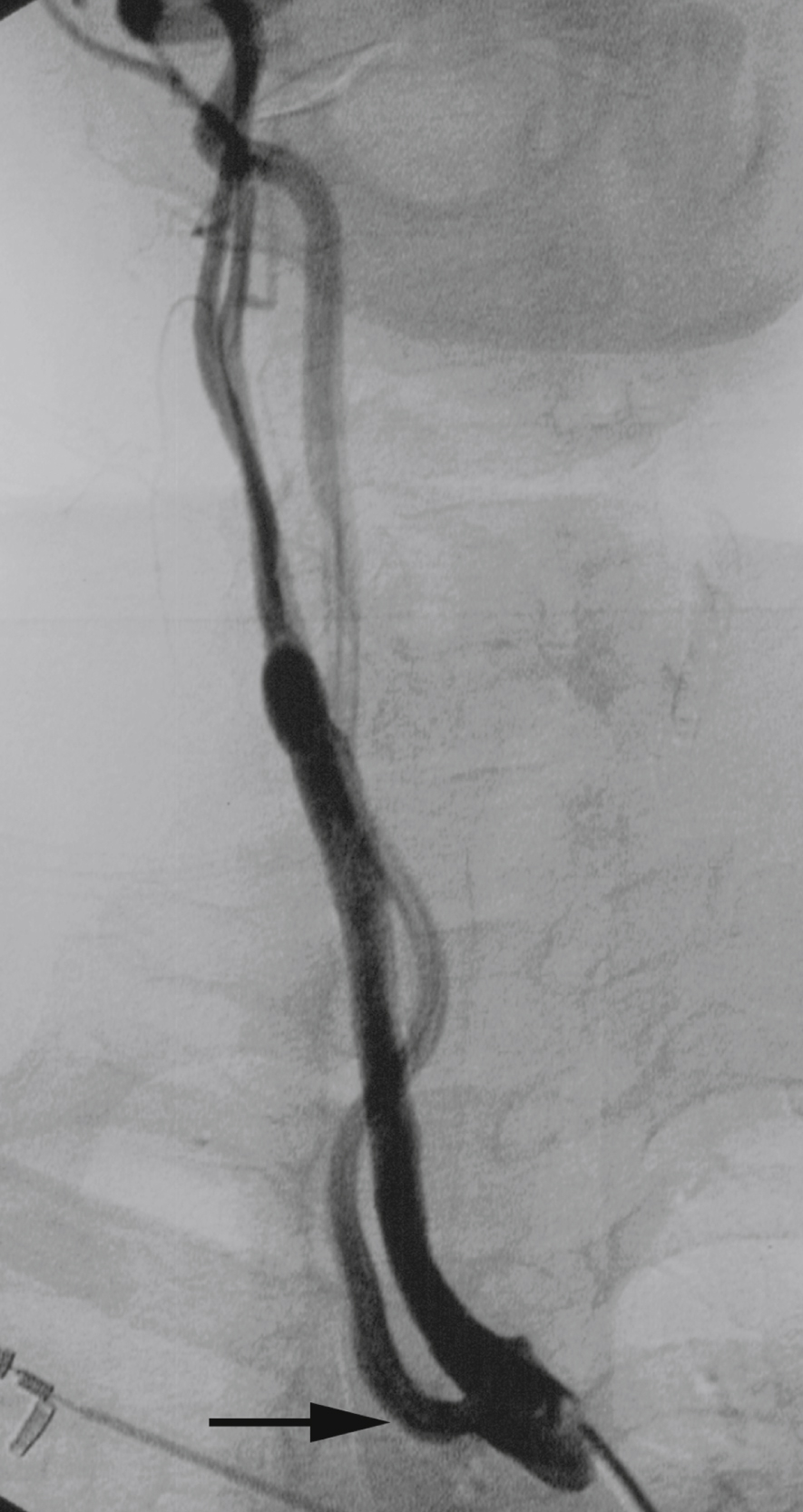 Fig. 56.1, Digital subtraction angiogram, right innominate injection, anteroposterior view showing a right vertebral artery (VA) ( arrow ) originating from right common carotid artery (CCA). This variant is generally associated with an aberrant right subclavian artery (arteria lusoria). Proximal origin of VA makes it easy to overlook during selective angiography of CCA.