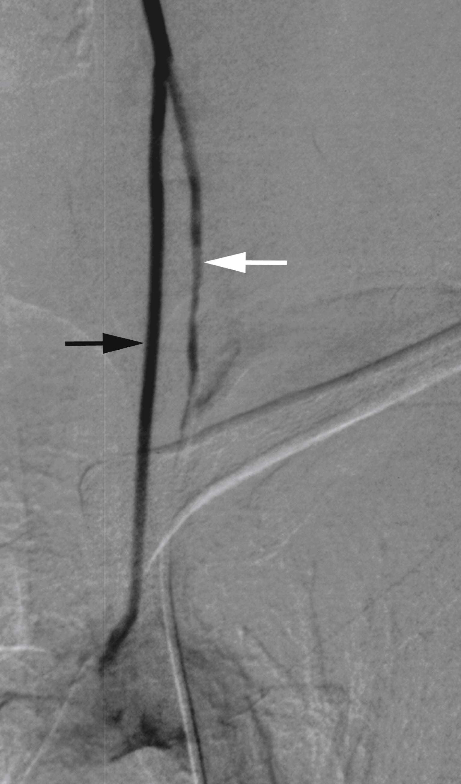 Fig. 56.11, Digital subtraction angiogram, left vertebral artery (VA) injection, anteroposterior view. Selective injection of left VA ( white arrow ) shows a slightly irregular artery that connects with a second VA root ( black arrow ) to form definitive VA. Second root, which arises directly from aortic arch, is opacified retrogradely.