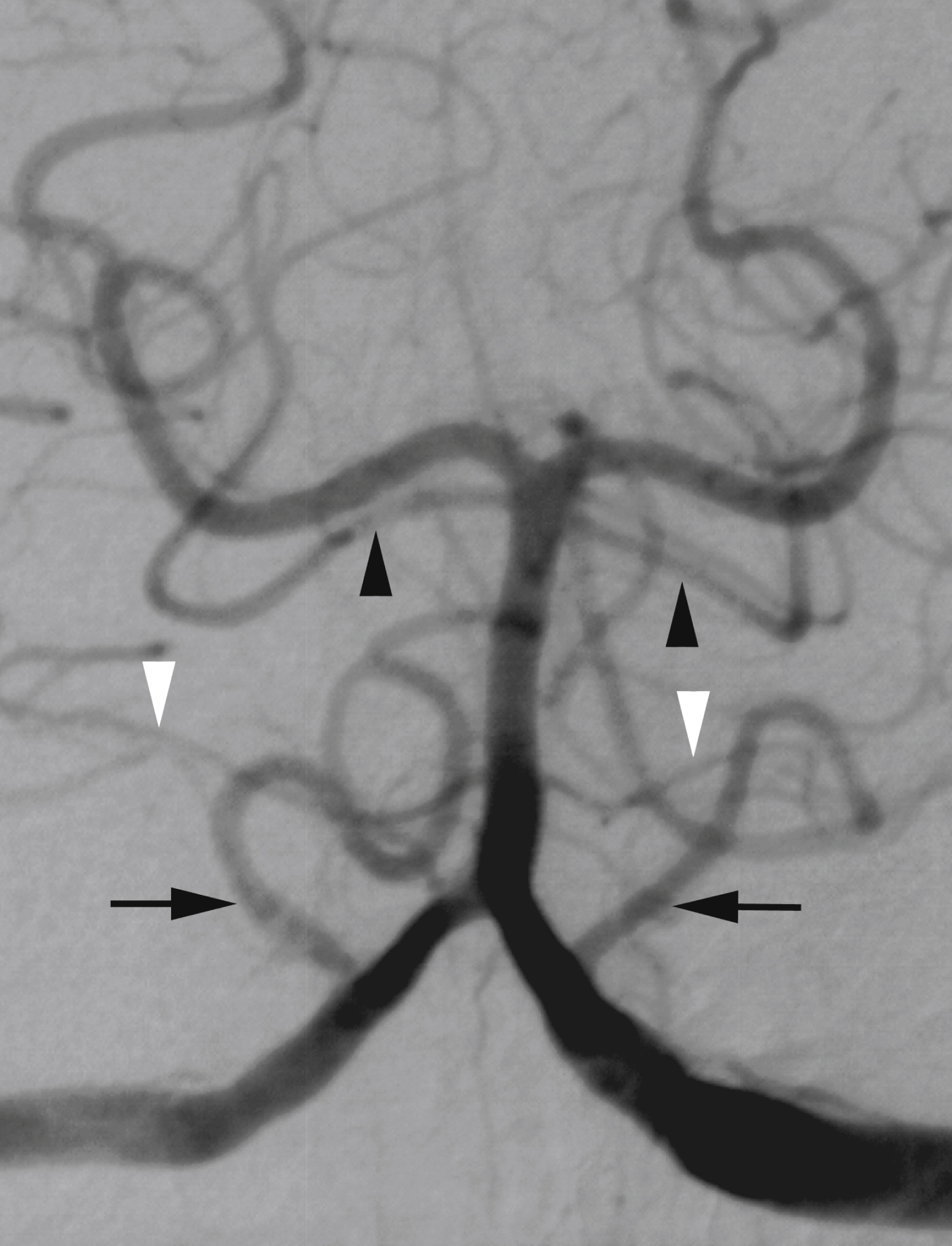 Fig. 56.12, Digital subtraction angiogram, left vertebral artery (VA) injection, anteroposterior view. Basilar artery is formed by junction of the two VAs. It ends in proximal portion of both proximal cerebral arteries (P1 segment). Posterior inferior cerebellar artery ( black arrows ), anterior inferior cerebellar artery ( white arrowheads ), and superior cerebellar artery (SCA) ( black arrowheads ) are documented. Note duplication of left SCA, which corresponds to separate origins of its vermian and hemispheric branches.