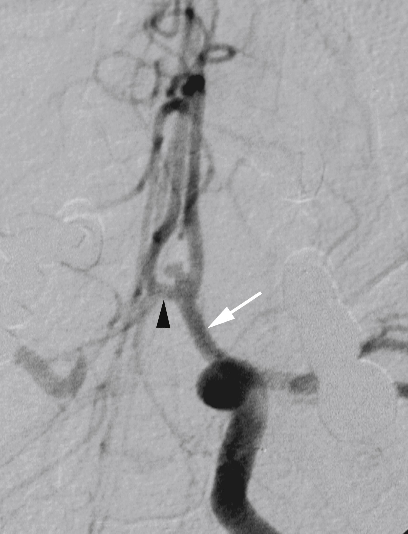 Fig. 56.13, Digital subtraction angiogram, left internal carotid artery injection, submentovertical view. Left A1 segment ( arrow ) is dominant, with a relatively large anterior communicating artery (AComA) ( arrowhead ). Small saccular aneurysm is seen at left A1-A2-AComA junction.