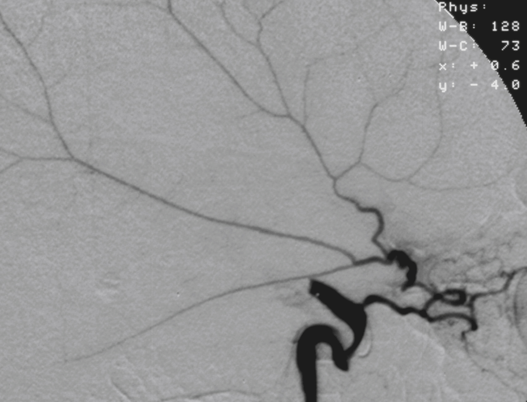 Fig. 56.3, Digital subtraction angiogram, internal carotid artery (ICA) injection, lateral view showing occlusion of ICA distal to origin of ophthalmic artery (OA). Middle meningeal artery originates from OA via its lacrimal branch.