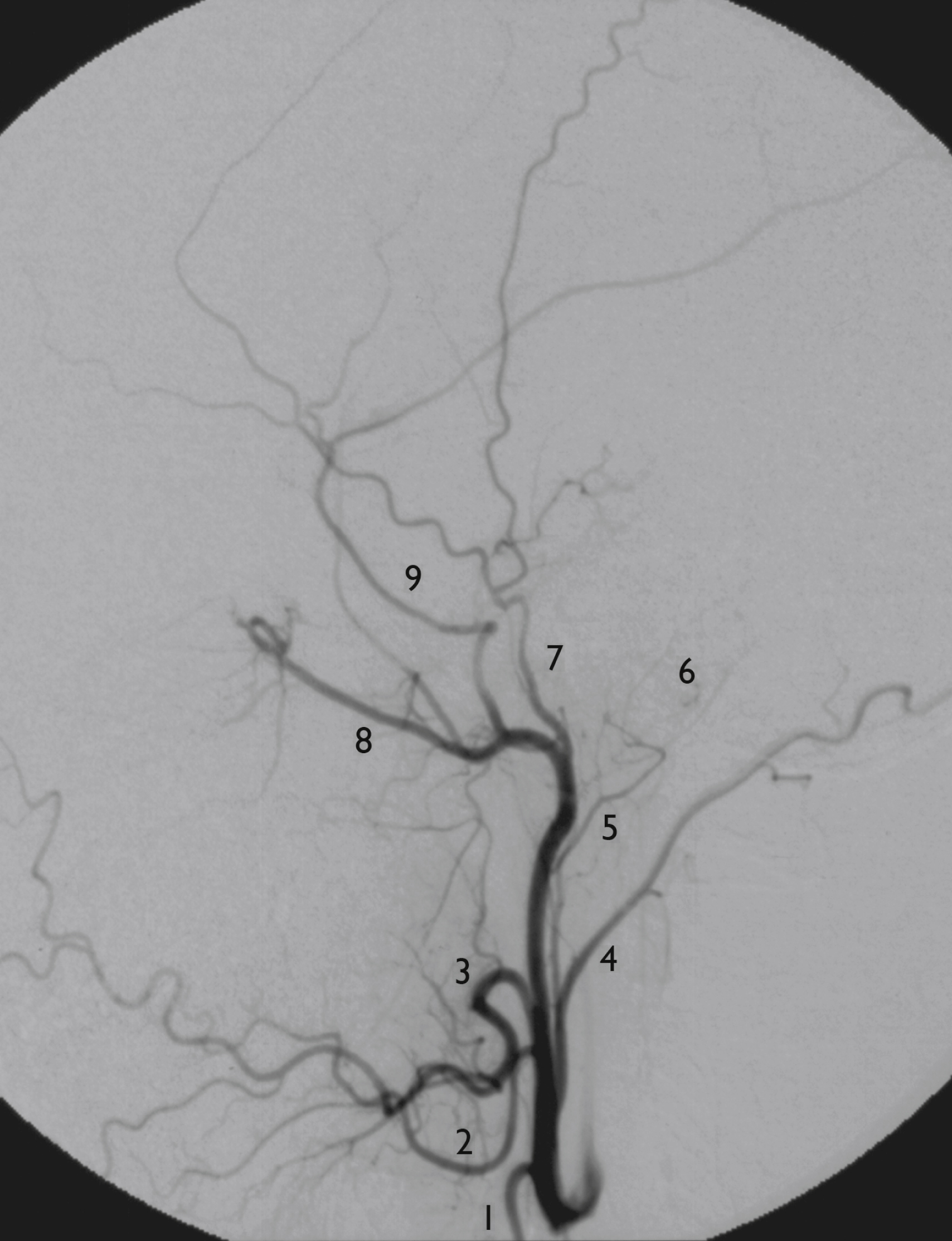 Fig. 56.2, Digital subtraction angiogram, selective external carotid artery (ECA) injection, lateral view. Main branches of ECA are ( 1 ) superior thyroid artery, ( 2 ) lingual artery, ( 3 ) facial artery, ( 4 ) occipital artery, ( 5 ) ascending pharyngeal artery, and ( 6 ) posterior auricular artery. ECA terminates in ( 7 ) superficial temporal artery and ( 8 ) maxillary artery, which provides ( 9 ) middle meningeal artery.
