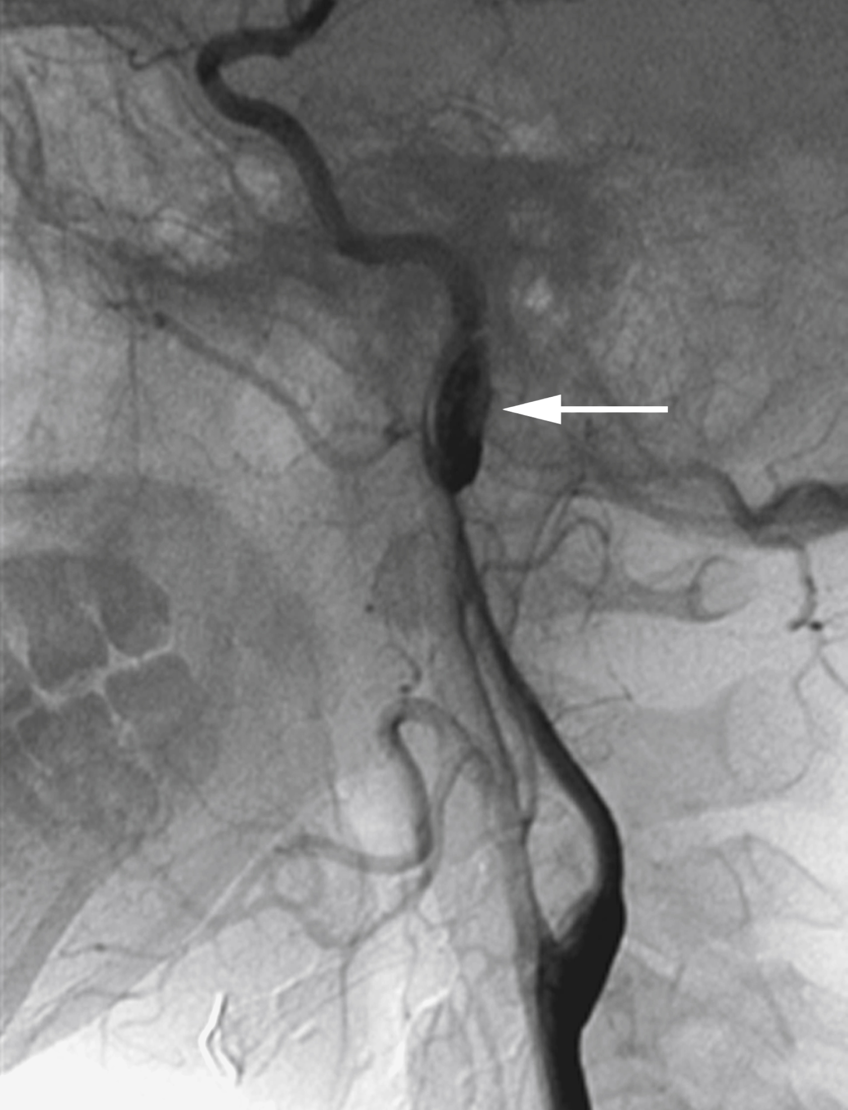 Fig. 56.4, Digital subtraction angiogram, common carotid artery injection, unsubtracted lateral view showing arterial dissection with pseudoaneurysm formation at junction between mobile cervical and fixed petrous segments of internal carotid artery ( arrow ).