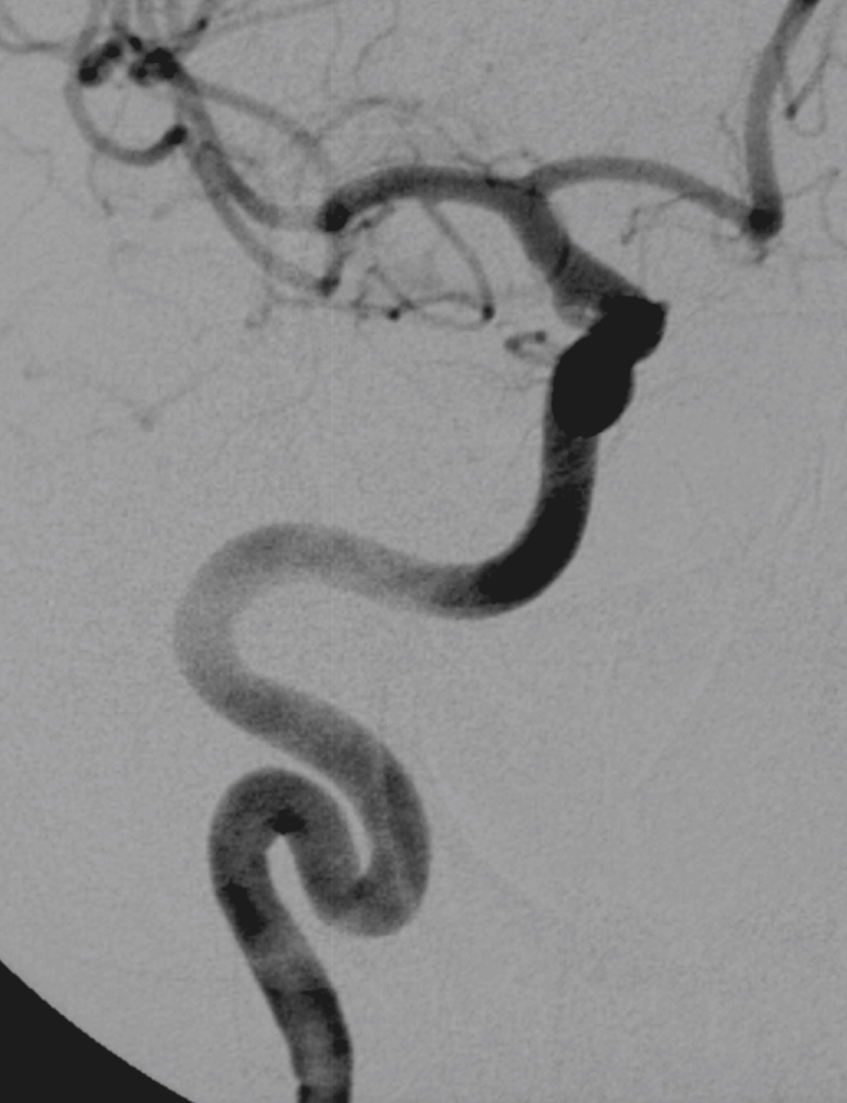 Fig. 56.5, Digital subtraction angiogram, internal carotid artery (ICA) injection, oblique view showing smooth congenital sinuosity of ICA.
