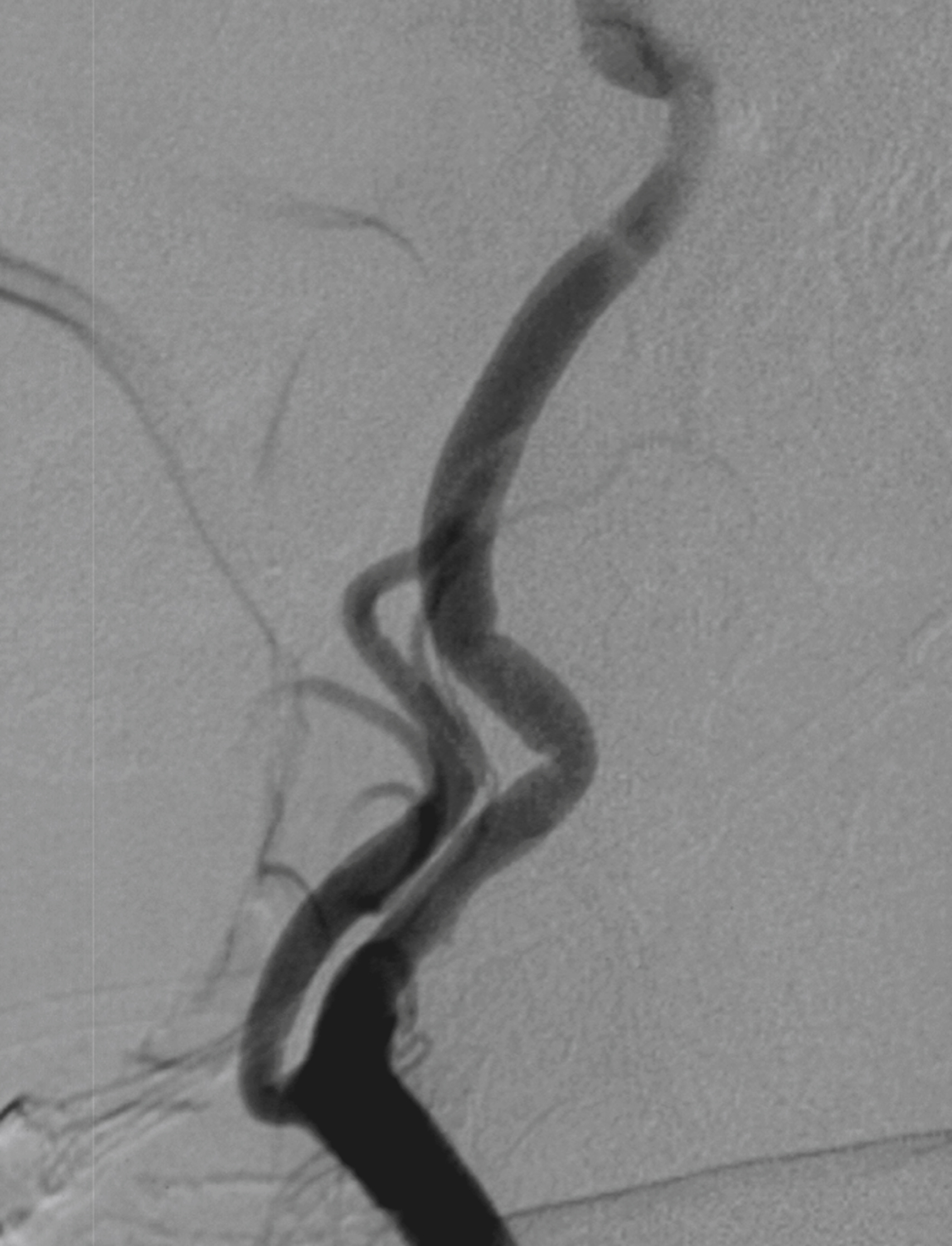 Fig. 56.6, Digital subtraction angiogram, common carotid artery injection, lateral view showing an acquired dolichoectatic internal carotid artery with a “lead pipe” appearance and kinking.