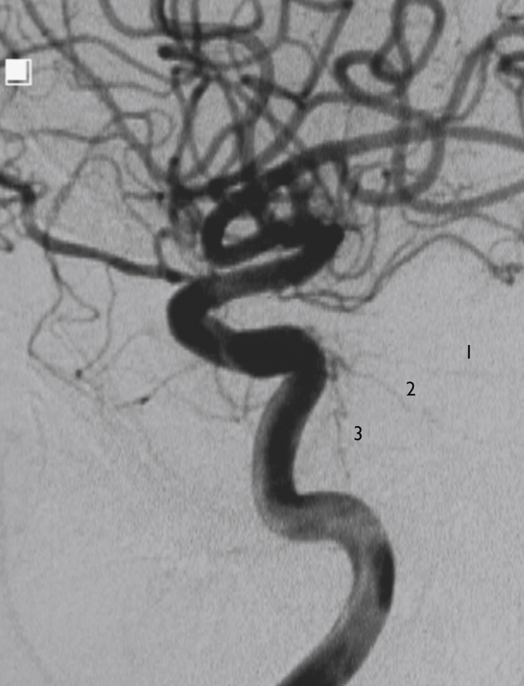 Fig. 56.7, Digital subtraction angiogram, internal carotid artery injection, lateral view. Main branches of meningohypophyseal trunk are ( 1 ) marginal tentorial artery, ( 2 ) basal tentorial artery, and ( 3 ) dorsal clival artery.